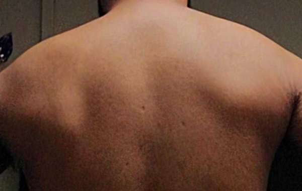 How to Fix Uneven Shoulders: Effective Exercises and Tips for Better Posture